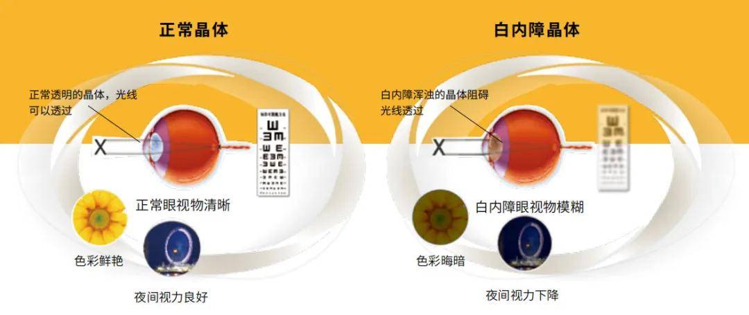 玻璃體混濁最新特效藥，突破與創(chuàng)新的治療策略