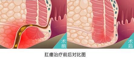 肛瘺的最新治療方法